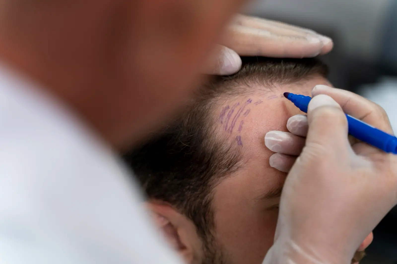 L’équipe medica impianta le unità follicolari con la penna implanter durante un trapianto di capelli DHI