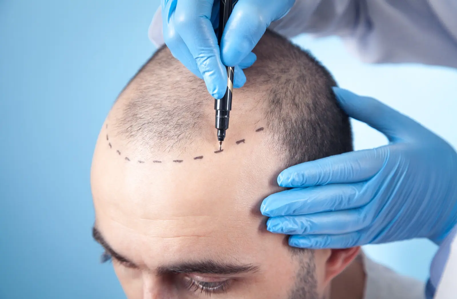 Il chirurgo disegna la linea frontale sulla fronte di un paziente prima di un trapianto di capelli FUE