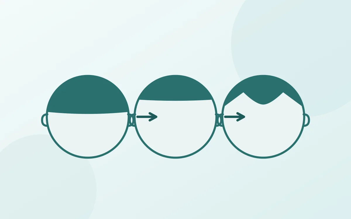 Illustrazione con tre teste che mostrano gli stadi dell alopecia androgenetica, dalla linea dei capelli piena alla stempiatura