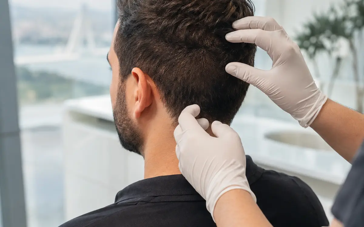 A clinician examining a patient's donor area at the back of the scalp before a hair transplant