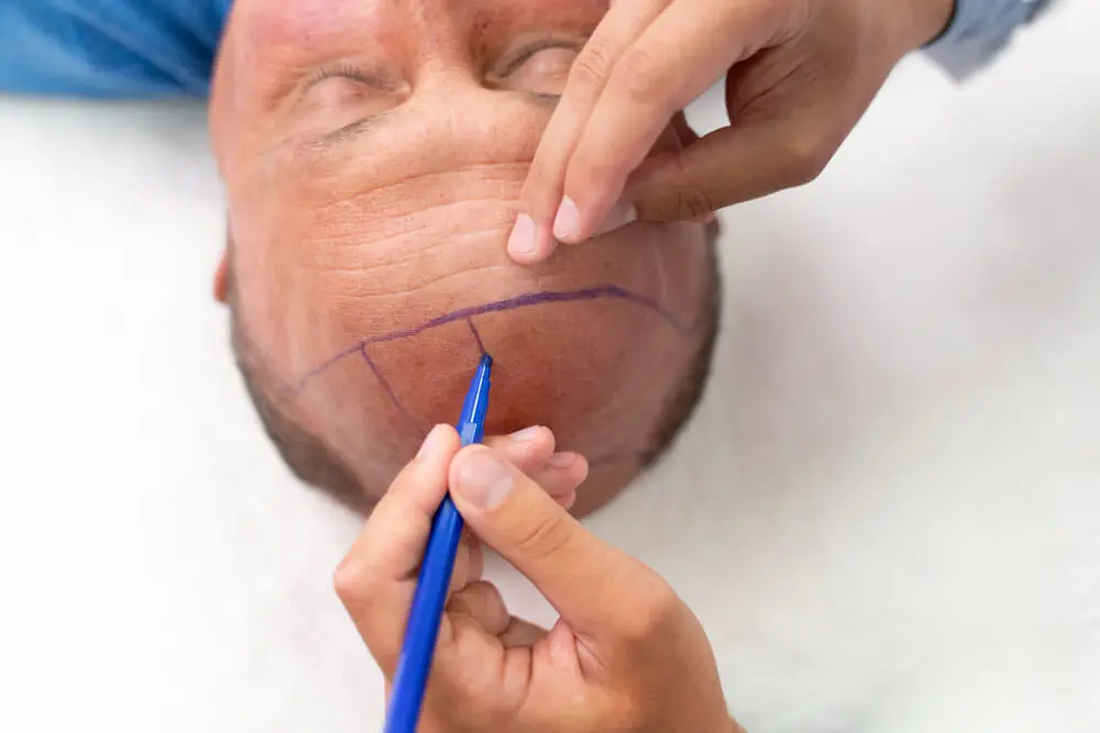 Un chirurgien dessine au marqueur la ligne capillaire planifiée sur un patient avant une greffe de cheveux