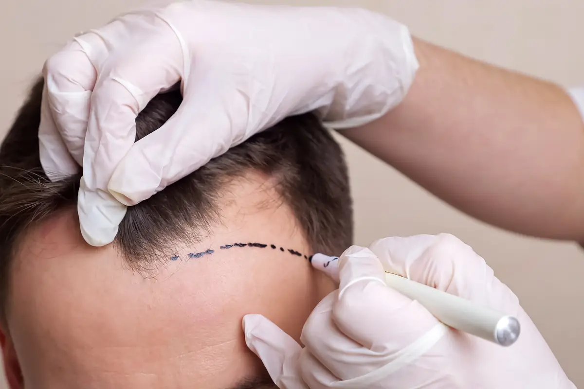 Des mains gantées tracent au feutre chirurgical la ligne des cheveux planifiée sur le front d'un patient avant une greffe de cheveux