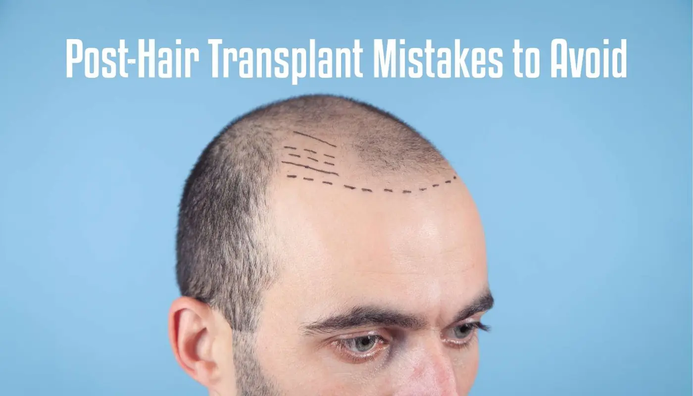 Erreurs à éviter après une greffe de cheveux, illustrées sur le cuir chevelu d'un patient marqué pour l'intervention