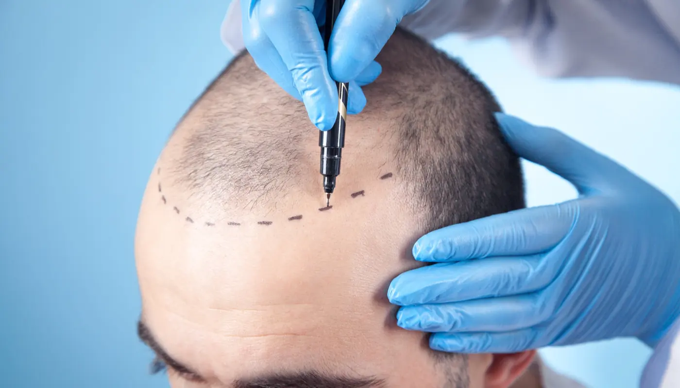 Nahaufnahme eines zurückweichenden Haaransatzes, der vor der Beurteilung mit einem Stift markiert wird