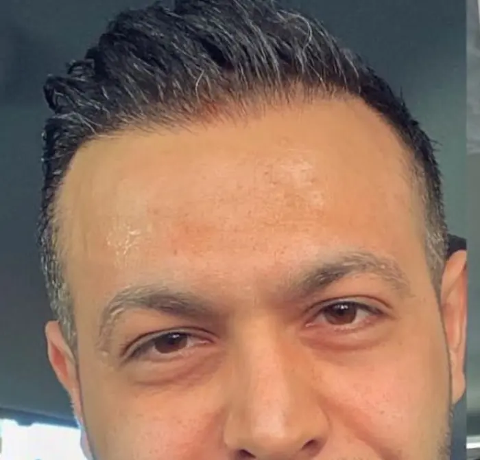 After: Cuero cabelludo antes y después de un injerto capilar, caso individual documentado de nuestra clínica