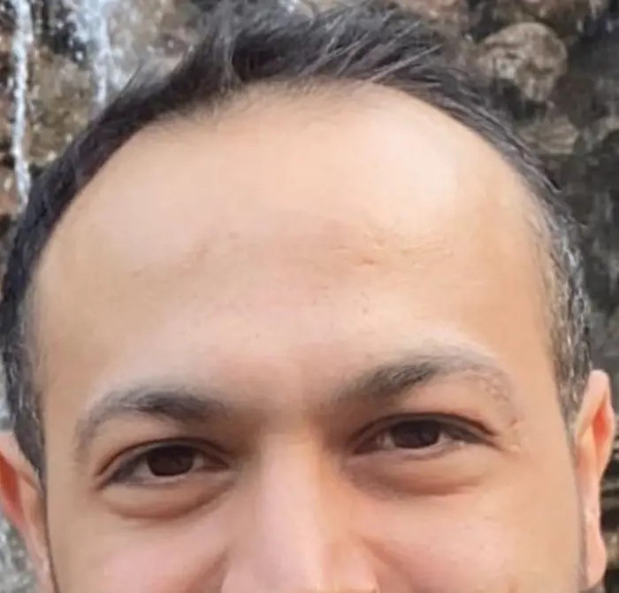Before: Cuero cabelludo antes y después de un injerto capilar, caso individual documentado de nuestra clínica