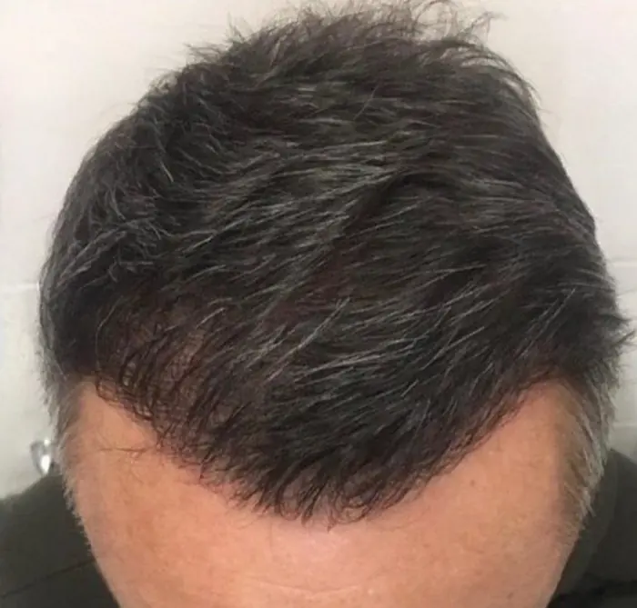 After: Cuero cabelludo antes y después de un injerto capilar, caso individual documentado de nuestra clínica