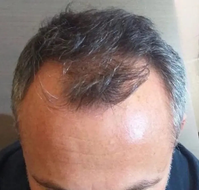 Before: Cuero cabelludo antes y después de un injerto capilar, caso individual documentado de nuestra clínica