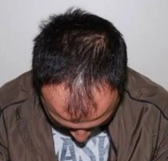 Before: Cuero cabelludo antes y después de un injerto capilar, caso individual documentado de nuestra clínica