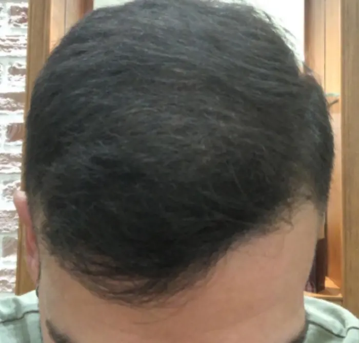 After: Cuero cabelludo antes y después de un injerto capilar, caso individual documentado de nuestra clínica