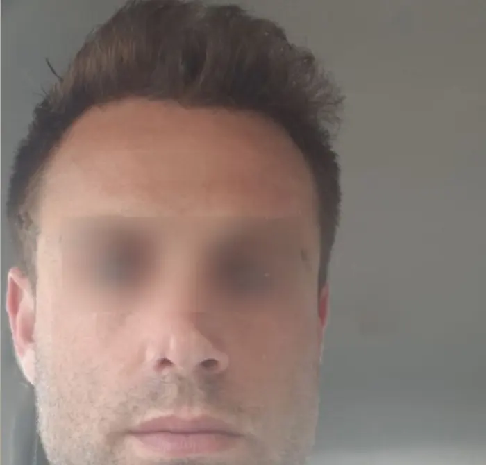 After: Cuero cabelludo antes y después de un injerto capilar, caso individual documentado de nuestra clínica