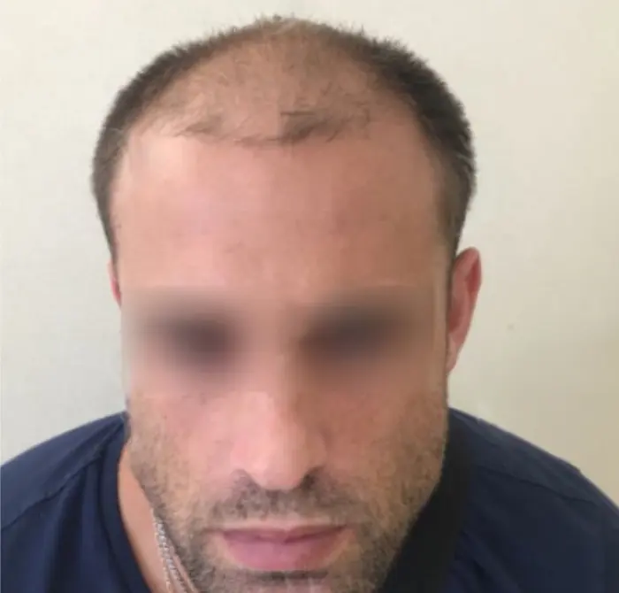 Before: Cuero cabelludo antes y después de un injerto capilar, caso individual documentado de nuestra clínica