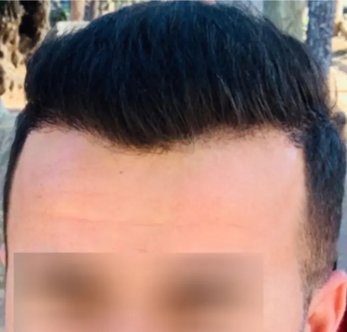 After: Cuero cabelludo antes y después de un injerto capilar, caso individual documentado de nuestra clínica