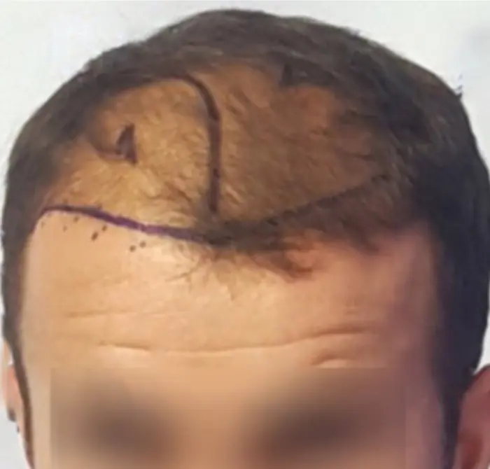 Before: Cuero cabelludo antes y después de un injerto capilar, caso individual documentado de nuestra clínica