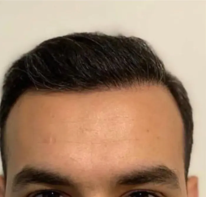 After: Cuero cabelludo antes y después de un injerto capilar, caso individual documentado de nuestra clínica