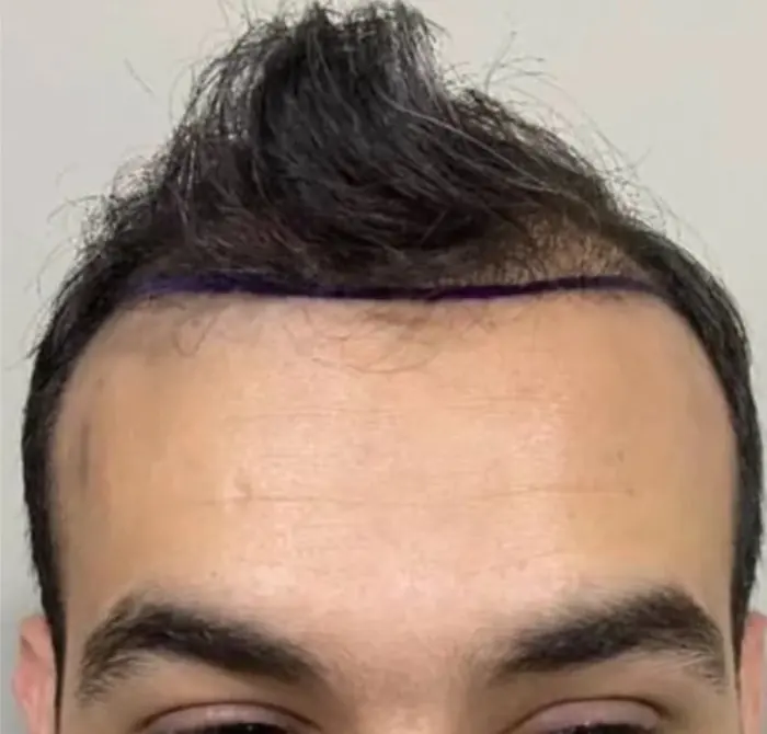 Before: Cuero cabelludo antes y después de un injerto capilar, caso individual documentado de nuestra clínica