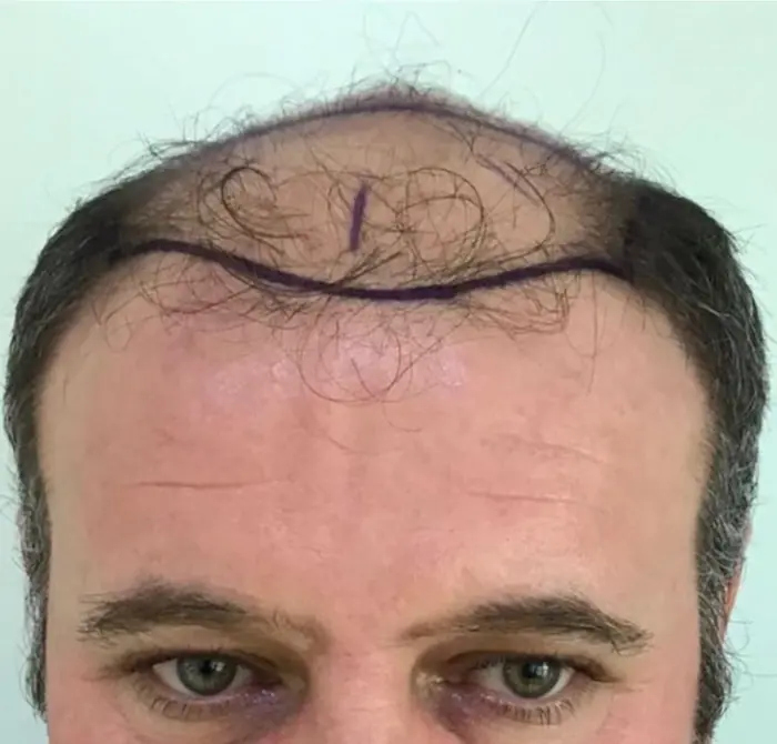 Before: Cuero cabelludo antes y después de un injerto capilar, caso individual documentado de nuestra clínica