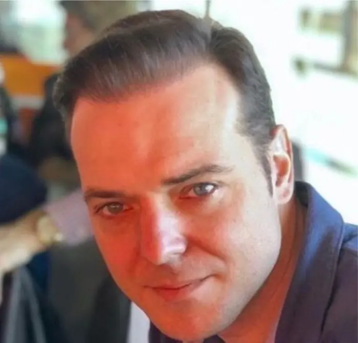 After: Cuero cabelludo antes y después de un injerto capilar, caso individual documentado de nuestra clínica