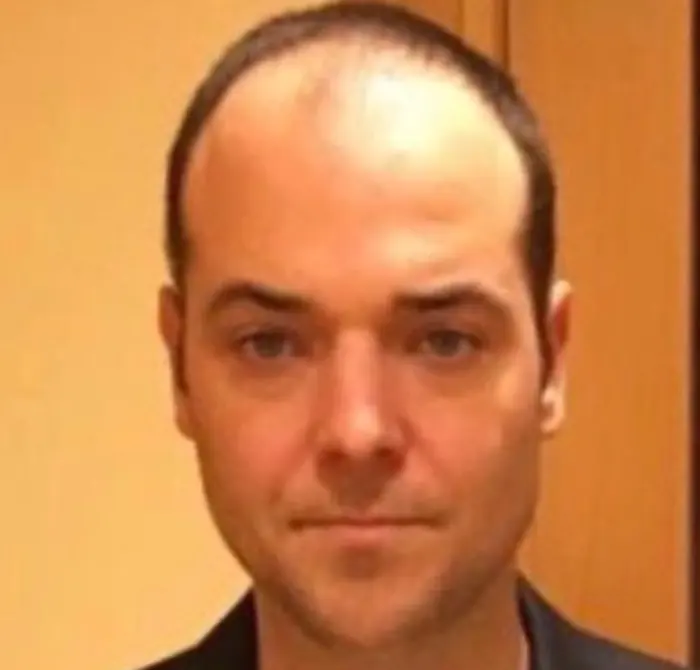 Before: Cuero cabelludo antes y después de un injerto capilar, caso individual documentado de nuestra clínica