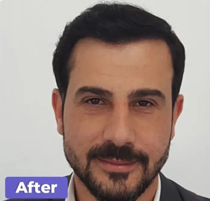 After: Línea capilar en retroceso con entradas marcadas, y después una línea capilar reconstruida, vista frontal