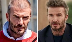 David Beckham Hair Transplant