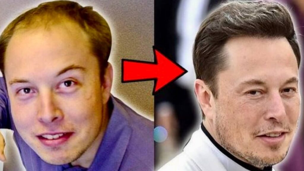 The Journey of Elon Musk Hair Transplant - Before & After