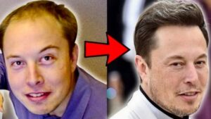 Elon-Musk-Hair-Transplant