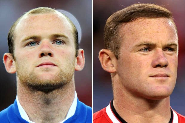 Hair Transplant Wayne Rooney