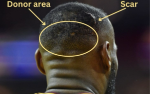 Lebron James hair transplant scar donor area