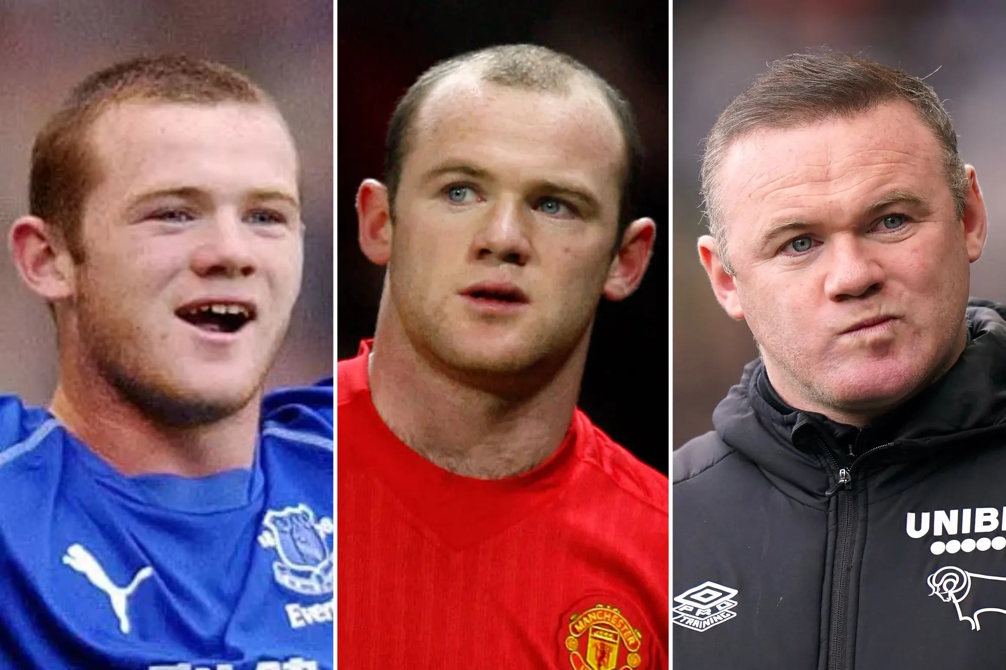 Great Hair Transplant Journey Wayne Rooney