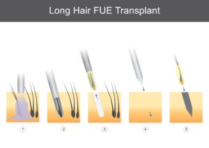 FUE hair transplant steps