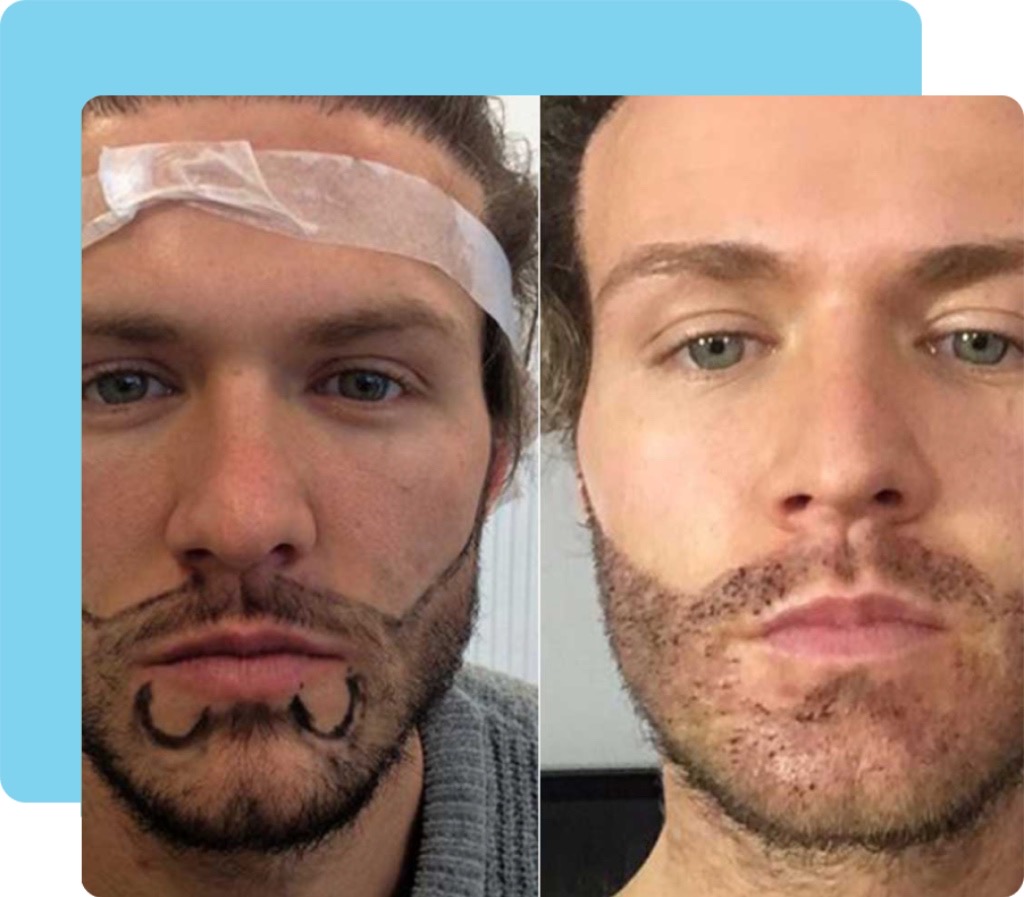 Beard Transplant in Turkey 1